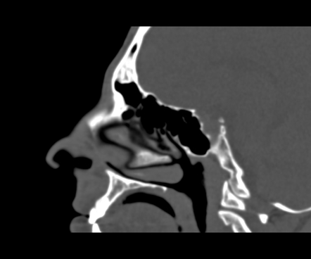 Frontal sinus osteoma | Image | Radiopaedia.org