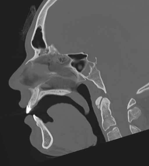 Penetrating brain injury via orbit | Image | Radiopaedia.org