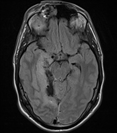 Penetrating brain injury via orbit | Image | Radiopaedia.org