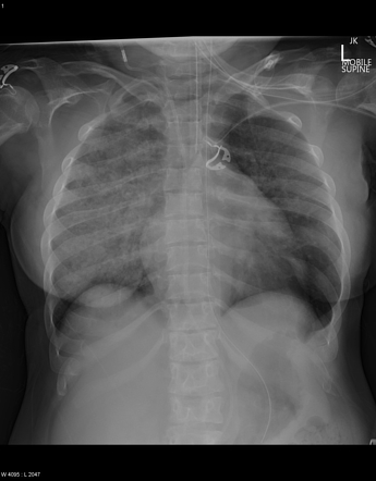 Unilateral Pulmonary Edema Radiology Reference Article Radiopaedia Org ...