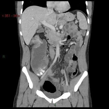 Colon cancer | Image | Radiopaedia.org