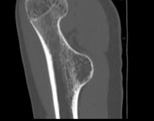 Osteochondroma - humerus | Image | Radiopaedia.org