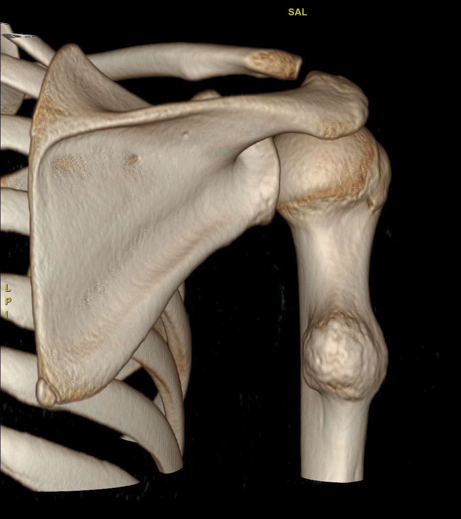 Osteochondroma - humerus | Image | Radiopaedia.org