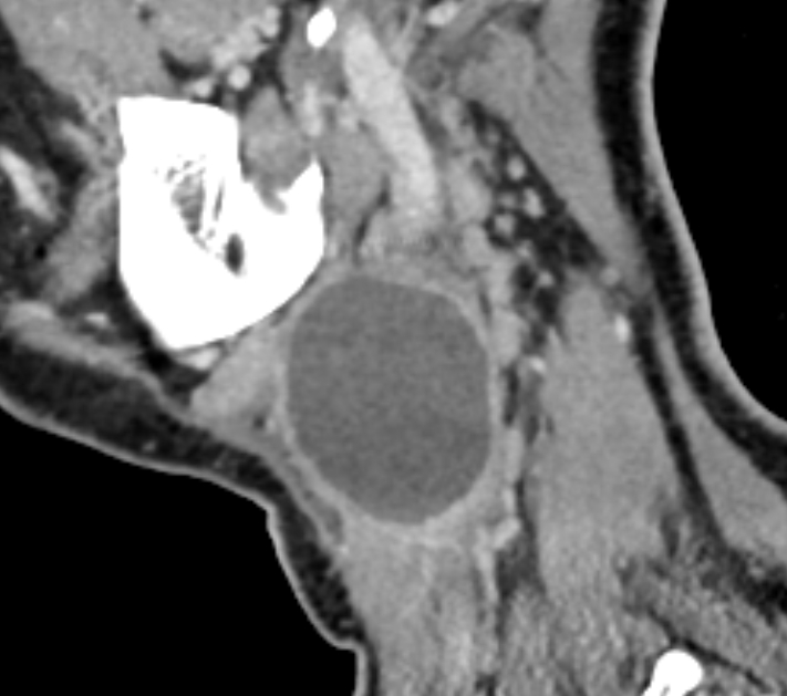 Second Branchial Cleft Cyst Image 5013