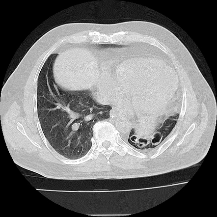 Unilateral pulmonary artery atresia | Radiology Case | Radiopaedia.org