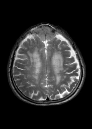 Intracranial meningioma with extracranial propagation | Image ...