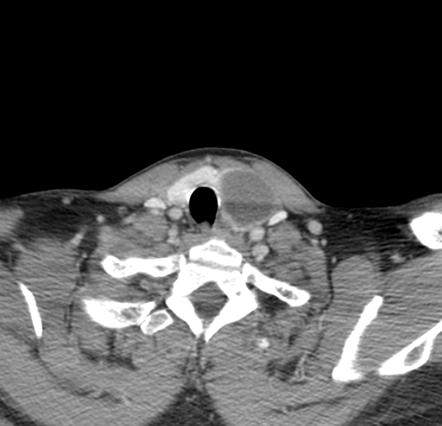 Colloid cyst of thyroid | Radiology Case | Radiopaedia.org