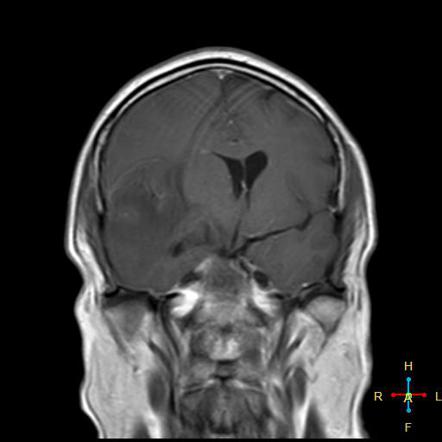 Subfalcine herniation | Radiology Reference Article | Radiopaedia.org