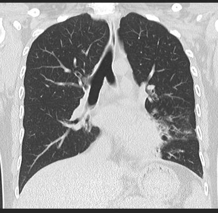 Bronchiectasis (summary) | Radiology Reference Article | Radiopaedia.org