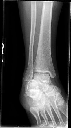 Osteochondritis dissecans | Radiology Case | Radiopaedia.org