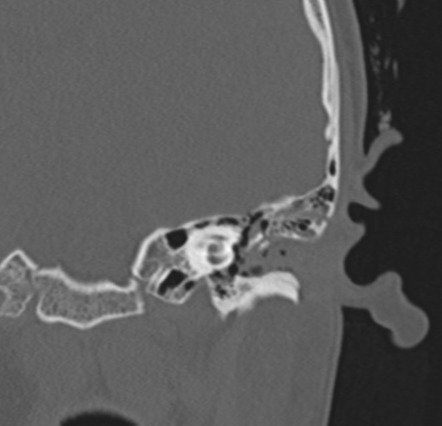 Longitudinal temporal bone fracture with incudo-malleolar disruption ...