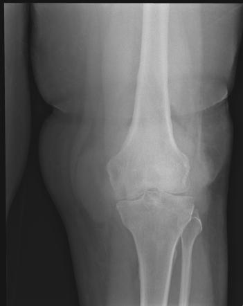 Pigmented villonodular synovitis- ultrasound | Image | Radiopaedia.org