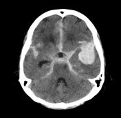 CT brain image gallery - SAH