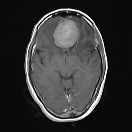 Olfactory groove meningioma | Radiology Case | Radiopaedia.org