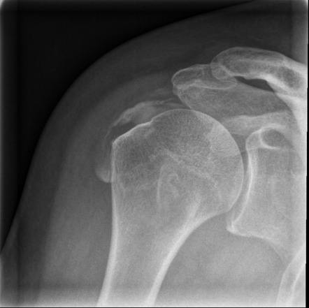 Calcific Tendinitis Radiology Reference Article Radiopaedia Org