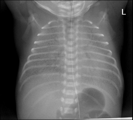 Respiratory Distress Syndrome Chest X Ray