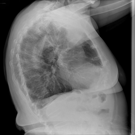 Low-grade Chondrosarcoma: Sternum 