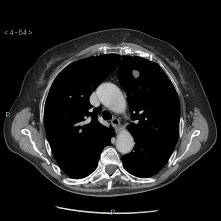 Low-grade chondrosarcoma: sternum | Image | Radiopaedia.org