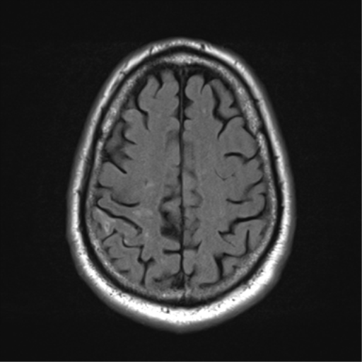 Cortical laminar necrosis | Image | Radiopaedia.org