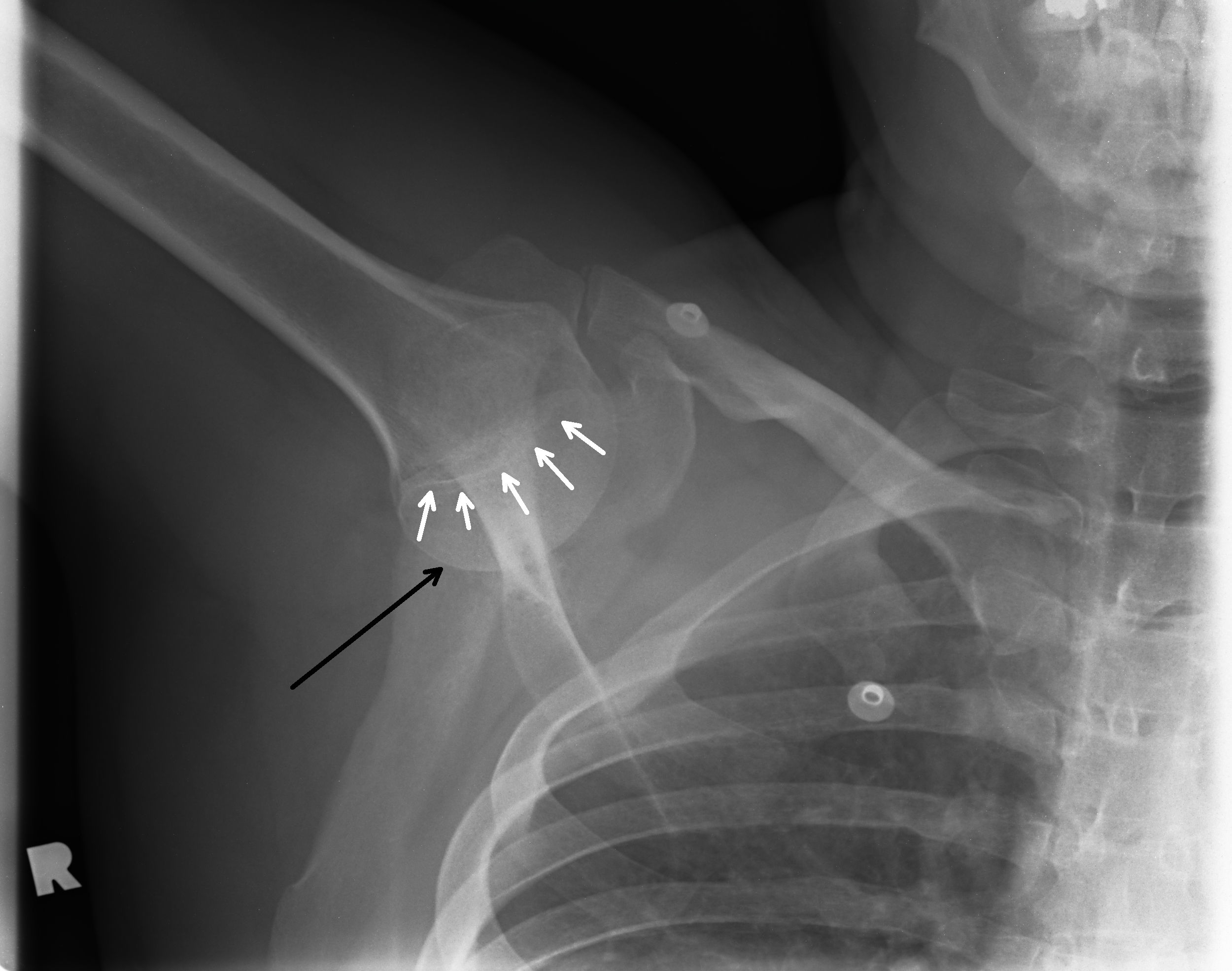 Luxatio erecta - inferior shoulder dislocation | Image | Radiopaedia.org