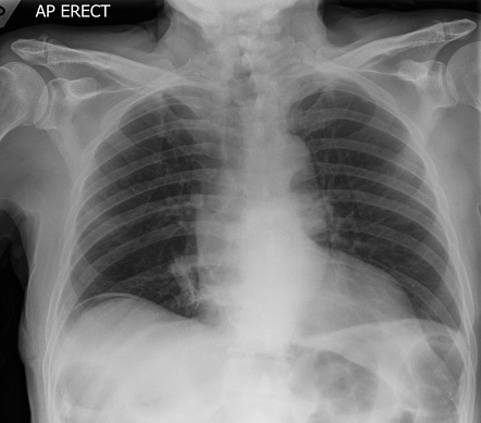 Pneumoperitoneum (small) | Radiology Case | Radiopaedia.org