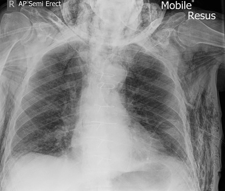 Ginkgo leaf sign of surgical emphysema | Radiology Case | Radiopaedia.org