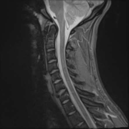 Unstable wedge fracture of C7 (hyperflexion injury) | Image ...