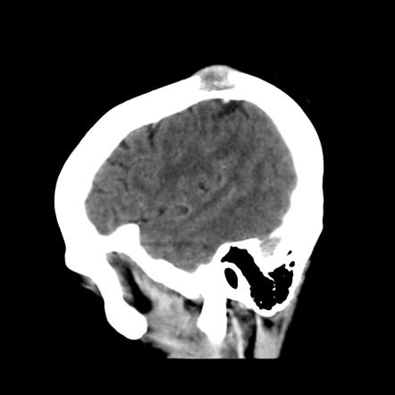 Osteolytic skull metastasis of lung cancer | Image | Radiopaedia.org