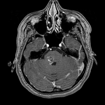 Cavernous malformation with DVA | Image | Radiopaedia.org