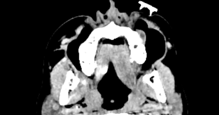 Periapical abscess | Radiology Case | Radiopaedia.org