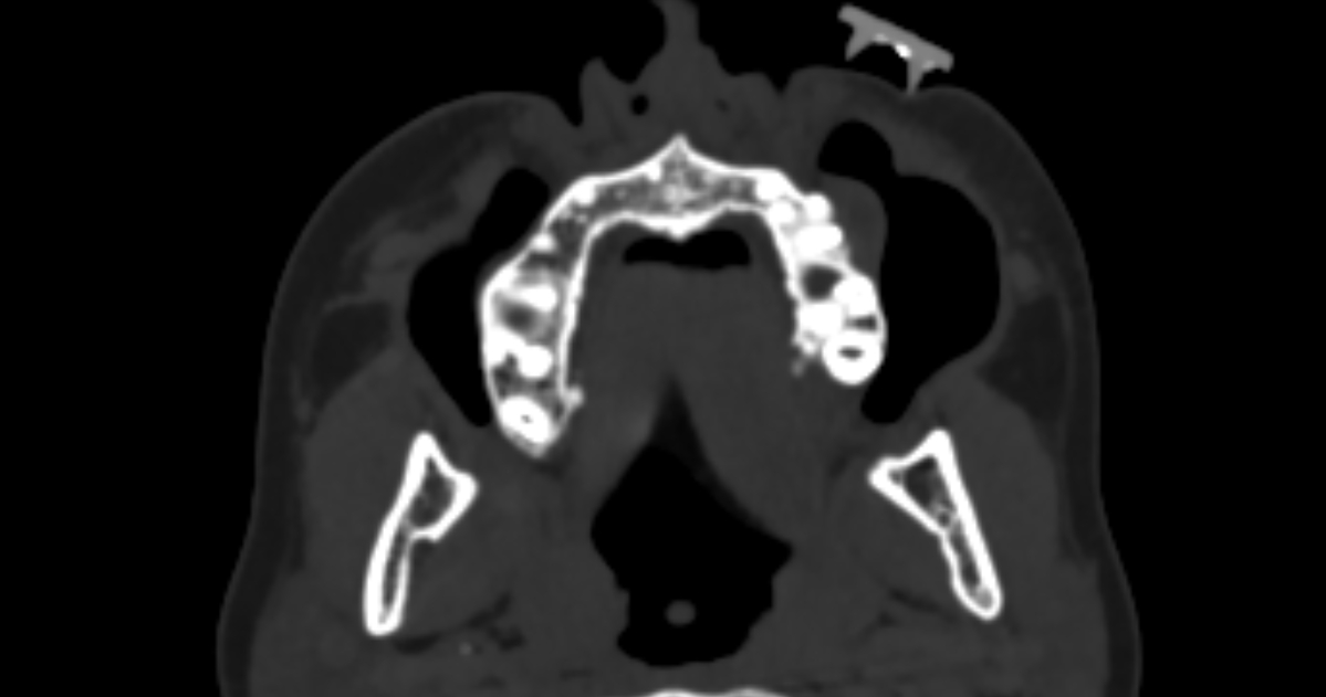 Periapical Abscess Drainage