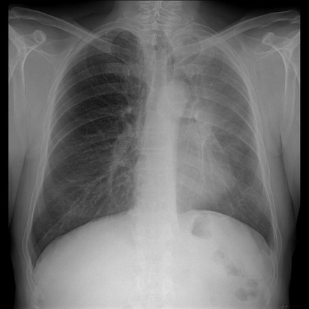 Brain metastases from squamocellular lung cancer | Image | Radiopaedia.org