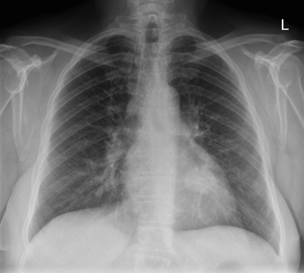 Lung cancer - retrocardiac | Radiology Case | Radiopaedia.org