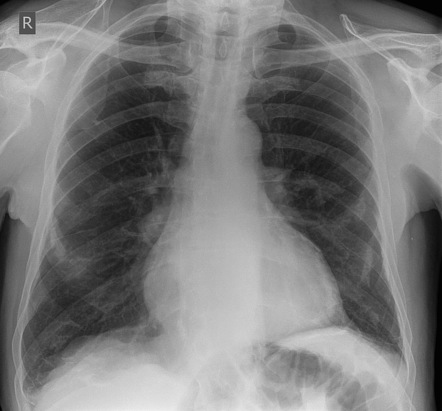 Calcified Pleural Plaques - Asbestos Exposure 