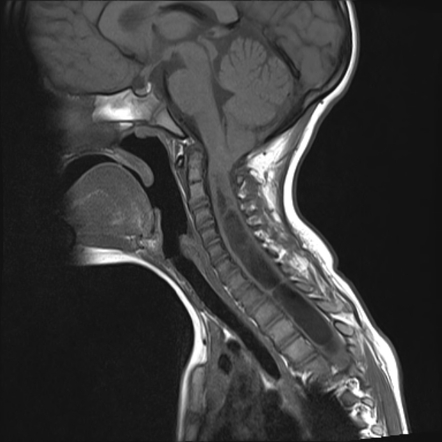 Chiari I malformation with syrinx | Image | Radiopaedia.org