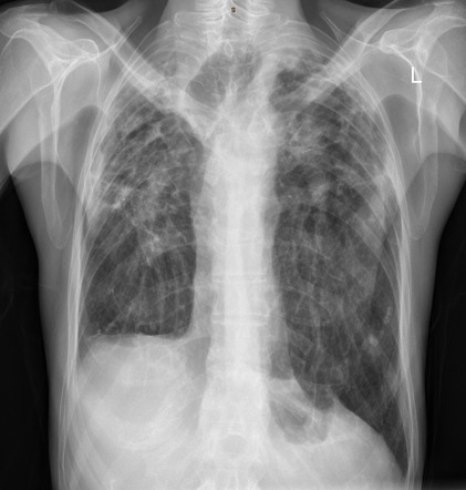 Tracheobronchomegaly in sarcoidosis | Radiology Case | Radiopaedia.org