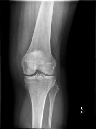 Patellar enthesopathy | Image | Radiopaedia.org