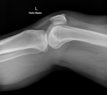 Patellar enthesopathy | Image | Radiopaedia.org