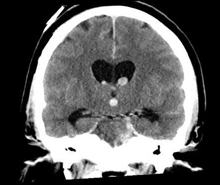 Superior cerebellar artery aneurysm | Image | Radiopaedia.org