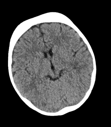 Thalassemia - skull manifestation | Image | Radiopaedia.org