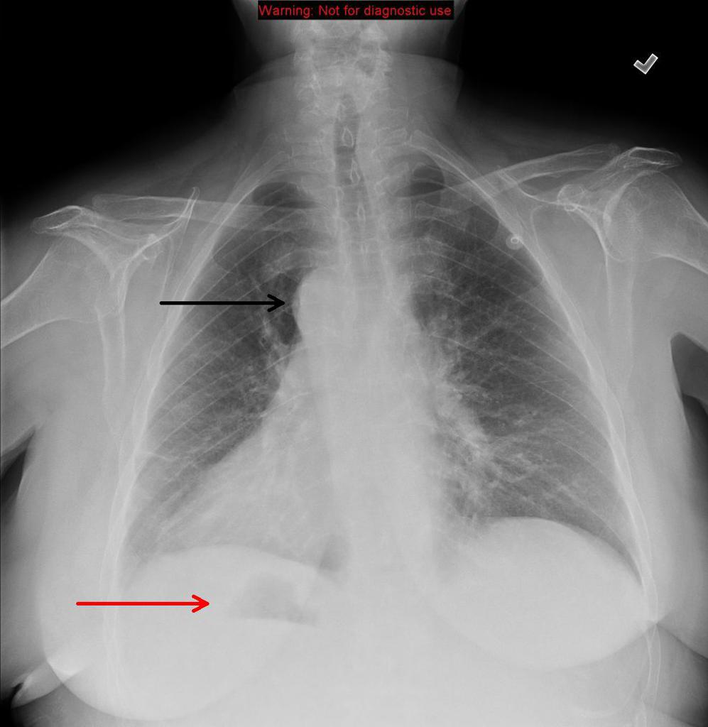 Dextrocardia Situs Inversus Radiology Case Radiopaedia Org