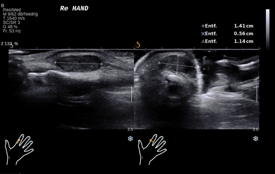 Giant cell tumor of the tendon sheath | Image | Radiopaedia.org