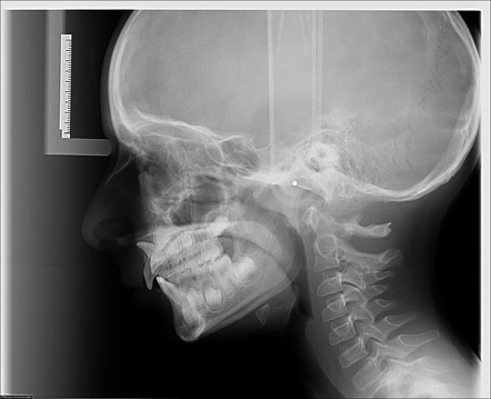 Dilaceration root | Radiology Case | Radiopaedia.org