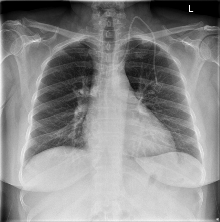 Tunneled Port-a-Cath tip with azygos vein termination | Image ...