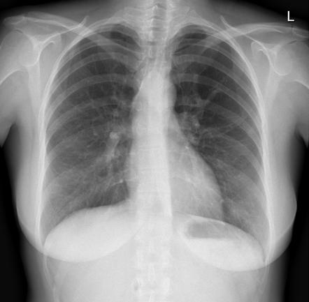 Bronchial atresia | Radiology Reference Article | Radiopaedia.org