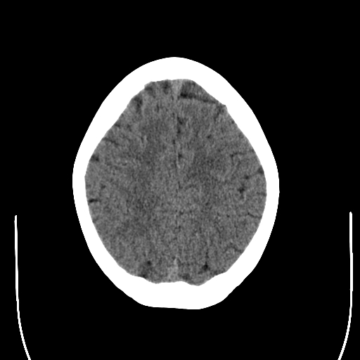 Intraventricular simple cyst | Image | Radiopaedia.org