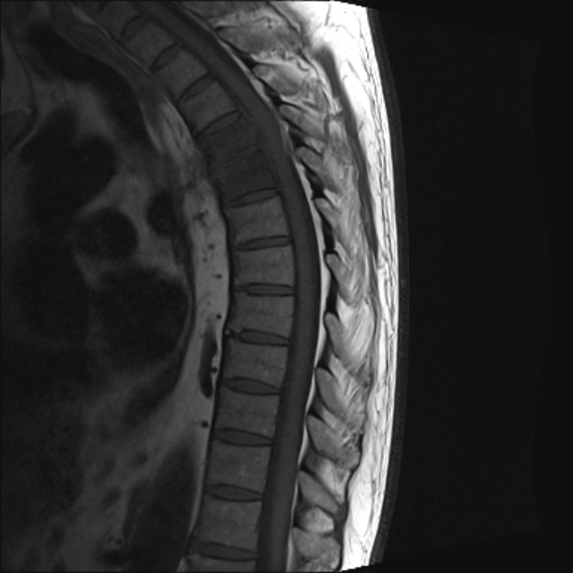 Spondylodiscitis | Image | Radiopaedia.org