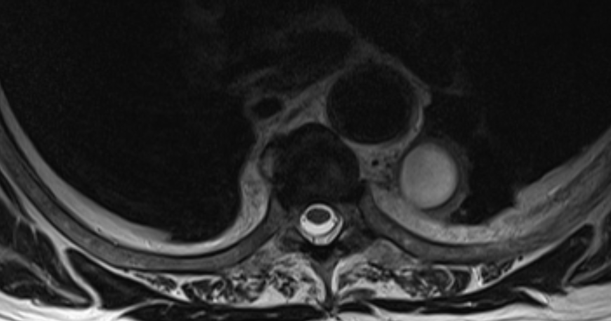 Spondylodiscitis | Image | Radiopaedia.org