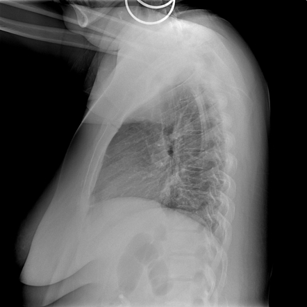 Central Venous Catheter | Radiology Reference Article | Radiopaedia.org