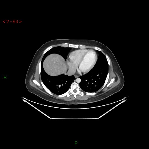 Metastatic Male Breast Cancer Image